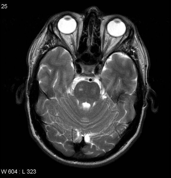 File:Neurosarcoidosis (Radiopaedia 10930-17204 Axial T2 6).jpg