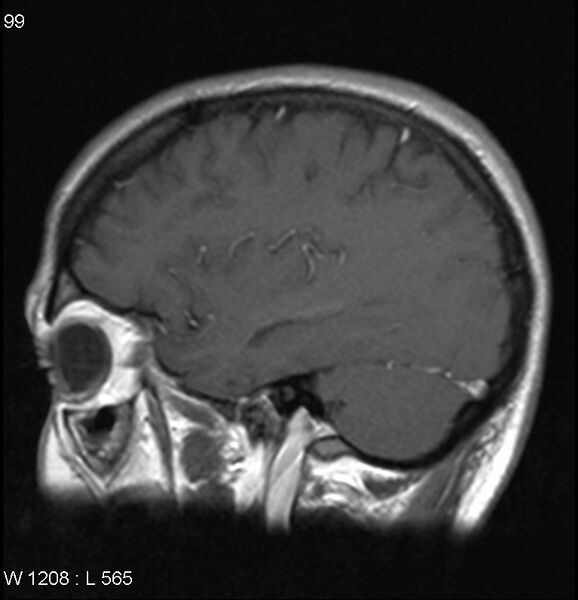 File:Neurosarcoidosis (Radiopaedia 10930-17204 Sagittal T1 C+ 4).jpg