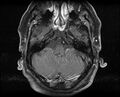 Non-Hodgkin lymphoma - parotid gland (Radiopaedia 71531-81890 Axial T1 C+ fat sat 22).jpg