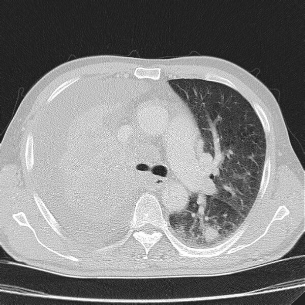 File:Non small-cell lung cancer (Radiopaedia 24467-24769 lung window 19).jpg