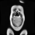 Normal MRI abdomen in pregnancy (Radiopaedia 88001-104541 Coronal T2 6).jpg