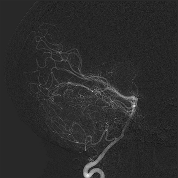 File:Normal cerebral angiogram (four vessel DSA) (Radiopaedia 41708-44649 L 9).png