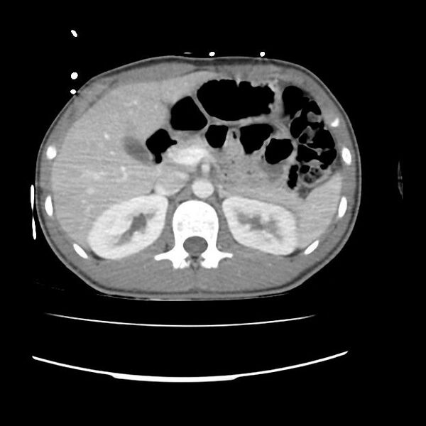 File:Normal dual-phase trauma CT chest,abdomen and pelvis (Radiopaedia 48092-52899 A 59).jpg