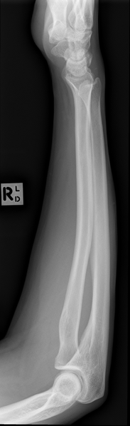 File:Normal forearm series (Radiopaedia 37491-39343 Lateral 1).png
