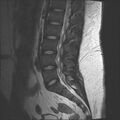 Normal lumbar spine MRI (Radiopaedia 47857-52609 Sagittal T2 9).jpg