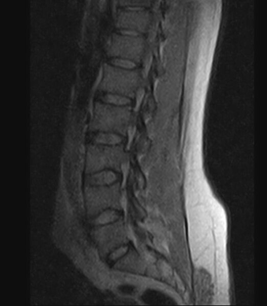File:Normal lumbar spine MRI - low-field MRI scanner (Radiopaedia 40976-43699 Sagittal T1 8).jpg