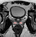 Normal prostate (MRI) (Radiopaedia 29986-30536 C 1).png