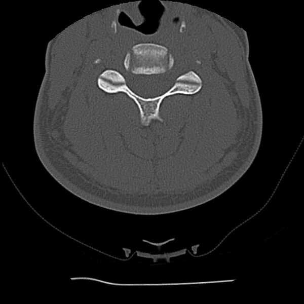 File:Normal trauma spine imaging (Radiopaedia 31753-32686 Axial bone window 42).jpg