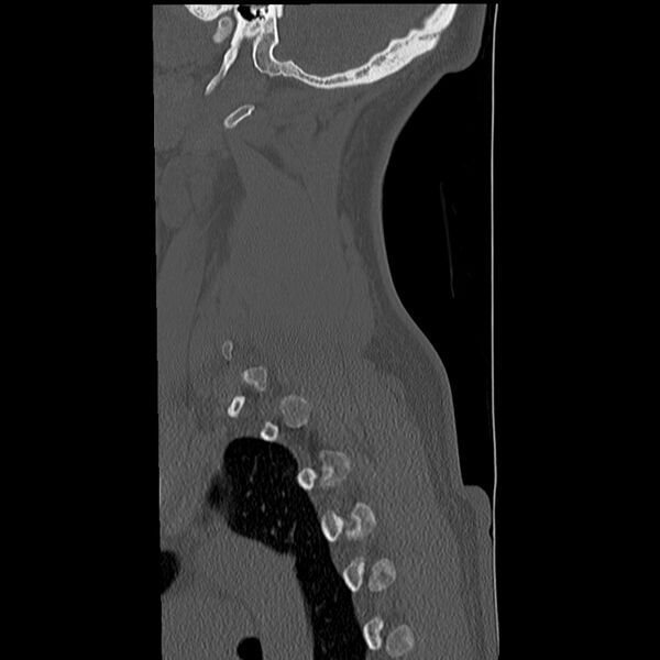 File:Normal trauma spine imaging (Radiopaedia 31753-32686 Sagittal bone window 38).jpg
