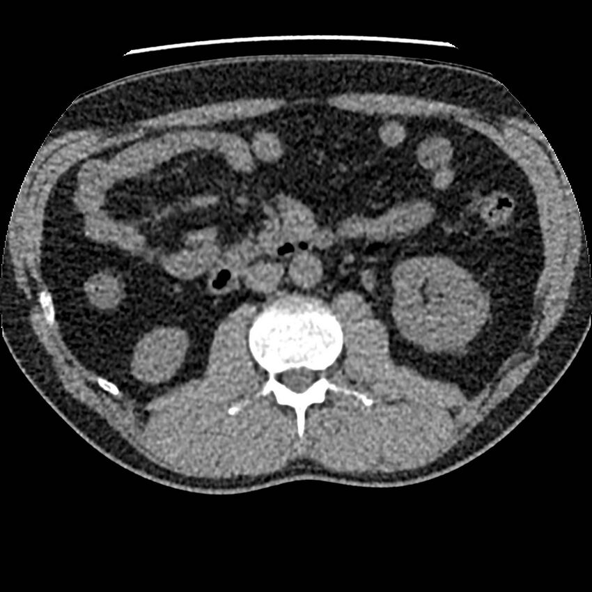 Obstructing ureteric calculus and ureteric anatomy (Radiopaedia 62730-71042 Axial non-contrast 52).jpg