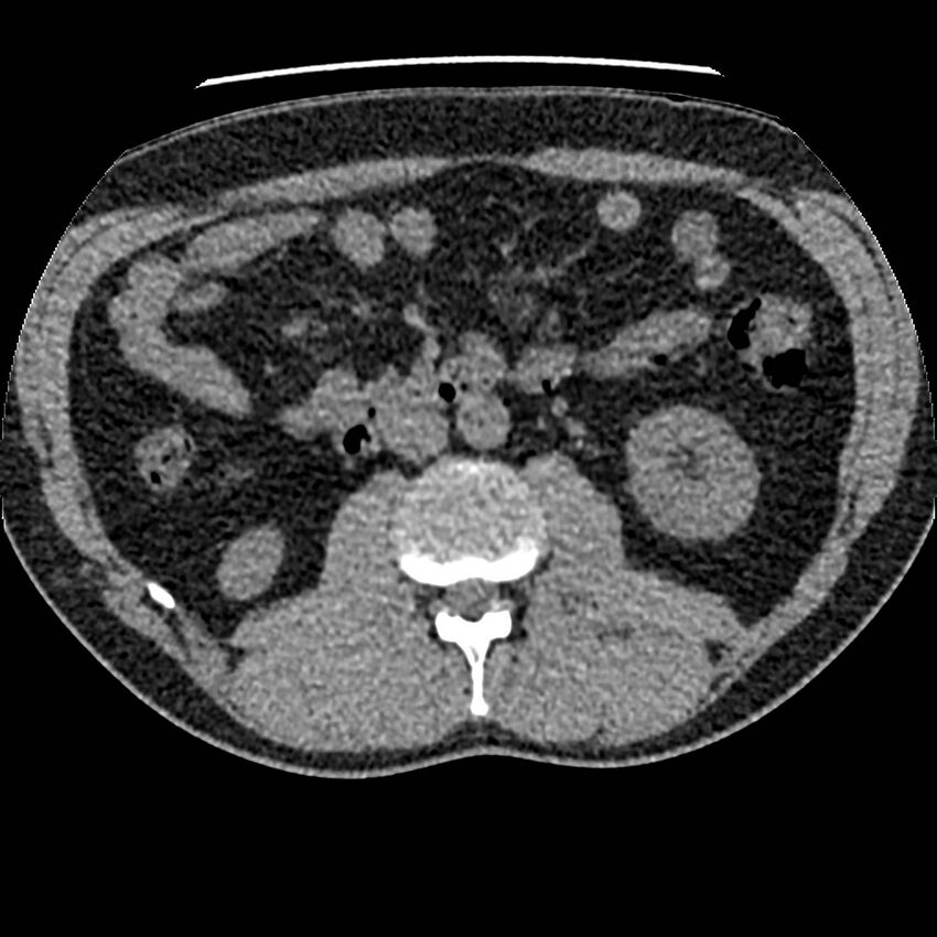 Obstructing ureteric calculus and ureteric anatomy (Radiopaedia 62730-71042 Axial non-contrast 55).jpg