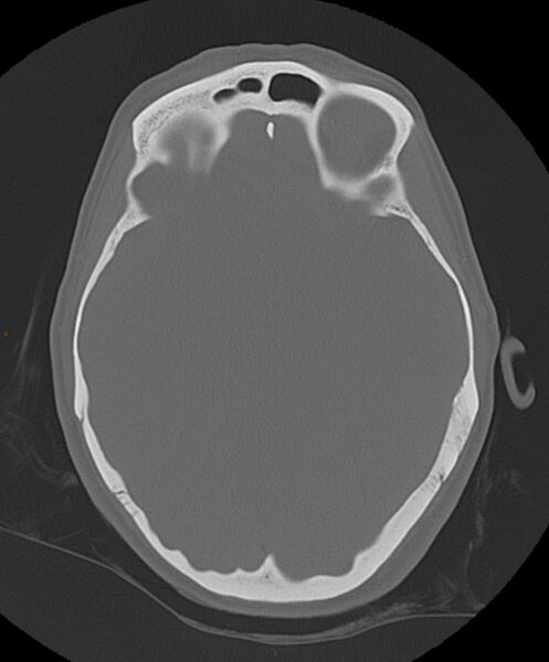 File:Occipital condyle fracture (Radiopaedia 61165-69056 Axial bone window 14).jpg