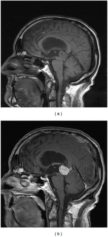 a,b)Parinaud's syndrome- sagittal and postcontrast sagittal images pineocytoma compressing the midbrain tectum