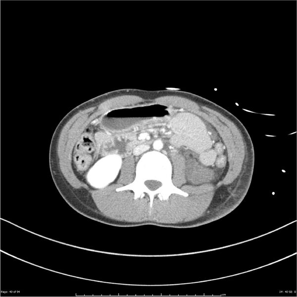 File:Traumatic renal artery dissection and pancreatic transection (Radiopaedia 37061-38739 Axial 223).jpg