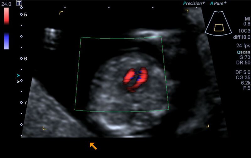 File:1st trimester nuchal-morphology ultrasound (Radiopaedia 44706-48477 Heart views cine with colour 103).jpg