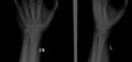3rd metacarpal shaft fracture (Radiopaedia 47786-52511 Frontal and oblique (magnified) 1).jpg