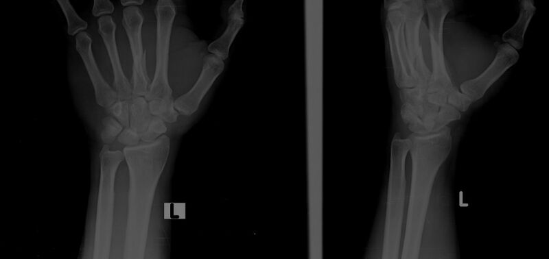 File:3rd metacarpal shaft fracture (Radiopaedia 47786-52511 Frontal and oblique (magnified) 1).jpg