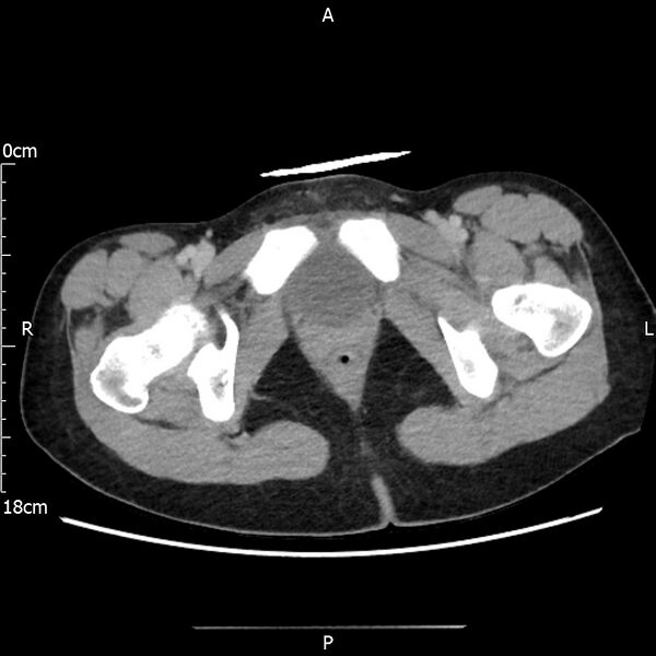 File:AAST grade IV kidney injury with CEUS follow-up (Radiopaedia 72353-82877 Axial C+ portal venous phase 79).jpg