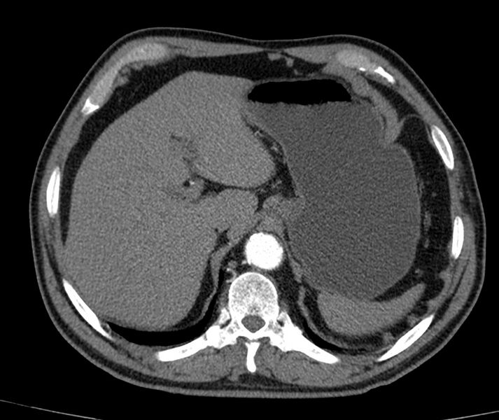 File:Abdominal aortic aneurysm (Radiopaedia 22421-22458 C+ arterial phase 2).jpg