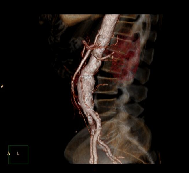 File:Abdominal aortic aneurysm (Radiopaedia 23703-23856 3D 20).jpg
