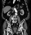 Abdominal aortic aneurysm (Radiopaedia 25855-26001 Coronal C+ arterial phase 43).jpg