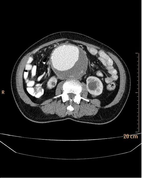 File:Abdominal aortic aneurysm (Radiopaedia 25985-26121 Axial C+ arterial phase 18).jpg