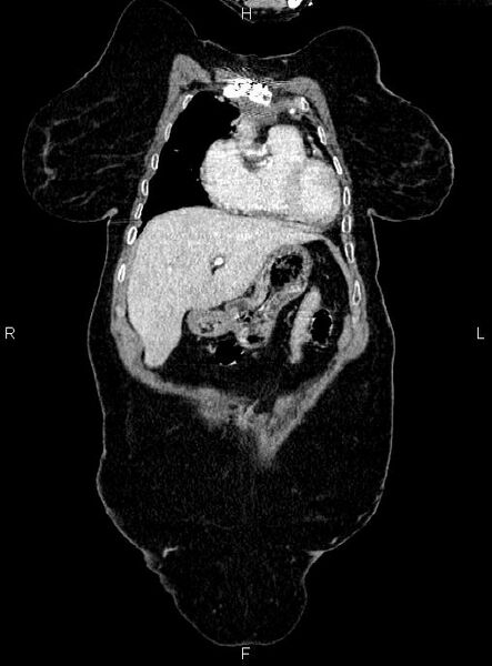 File:Abdominal aortic aneurysm (Radiopaedia 85063-100606 Coronal C+ arterial phase 6).jpg