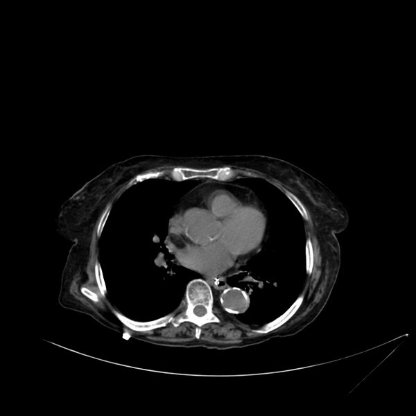 File:Abdominal aortic aneurysm - impending rupture (Radiopaedia 19233-19246 Axial non-contrast 1).jpg