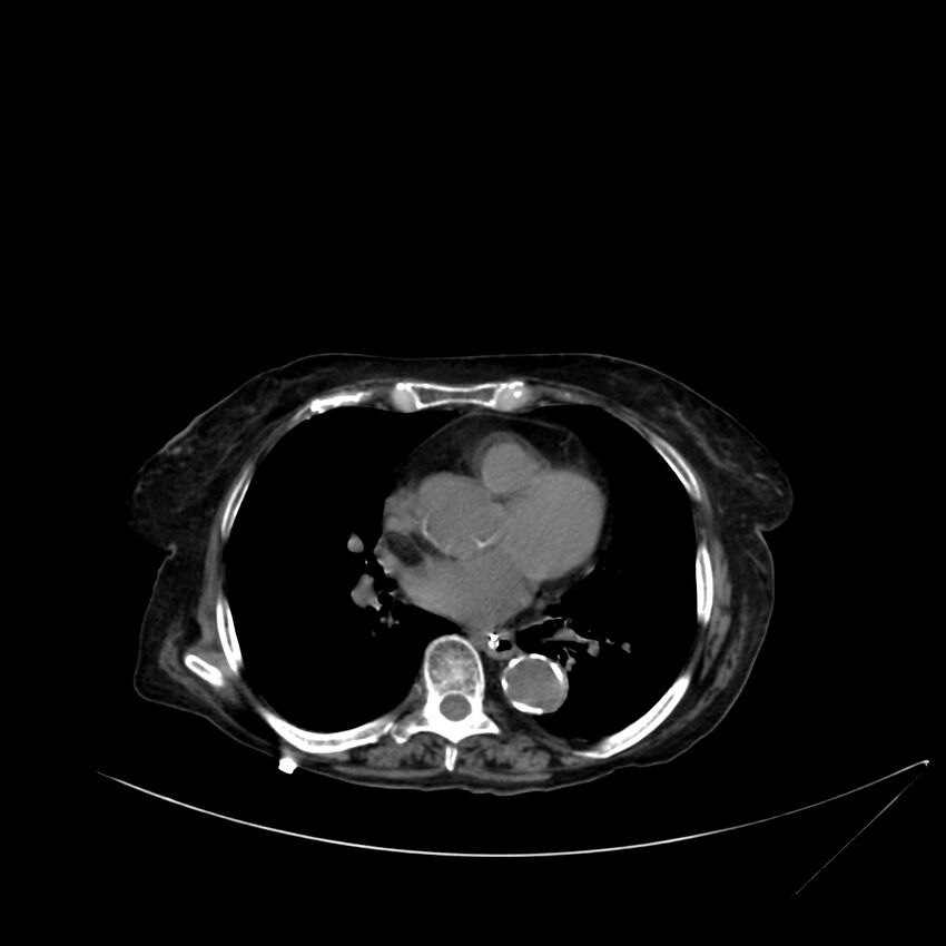 Abdominal aortic aneurysm - impending rupture (Radiopaedia 19233-19246 Axial non-contrast 1).jpg