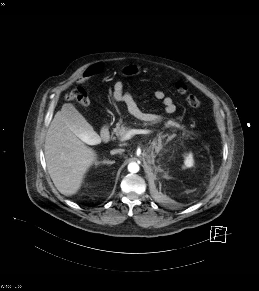 Abdominal aortic aneurysm with intramural hematoma then rupture (Radiopaedia 50278-55632 Axial C+ arterial phase 54).jpg