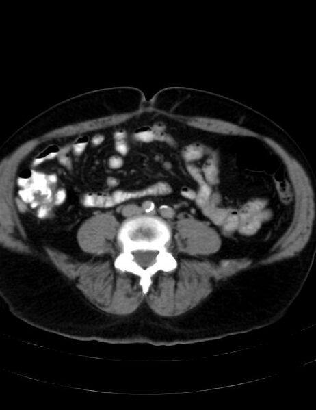 File:Abdominal lymphoma - with sandwich sign (Radiopaedia 53486-59492 Axial C+ portal venous phase 32).jpg