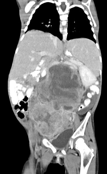 File:Abdominopelvic rhabdomyosarcoma (Radiopaedia 78356-90984 Coronal C+ portal venous phase 55).jpg