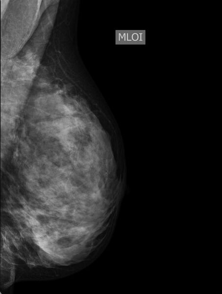 File:Accessory breast tissue (Radiopaedia 77479-89621 D 1).jpg
