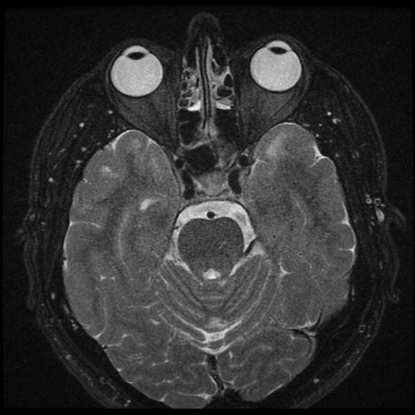 File:Acoustic schwannoma - intracanalicular (Radiopaedia 37247-39024 Axial T2 fat sat 12).jpg