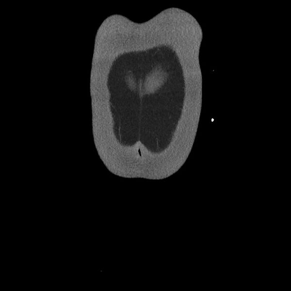 File:Active colonic bleed on CT (Radiopaedia 49765-55025 Coronal art MIP 6).jpg