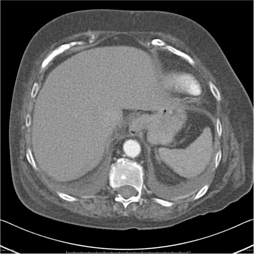 Acute-on-chronic pulmonary emboli (Radiopaedia 27925-28169 C+ CTPA 74).jpg