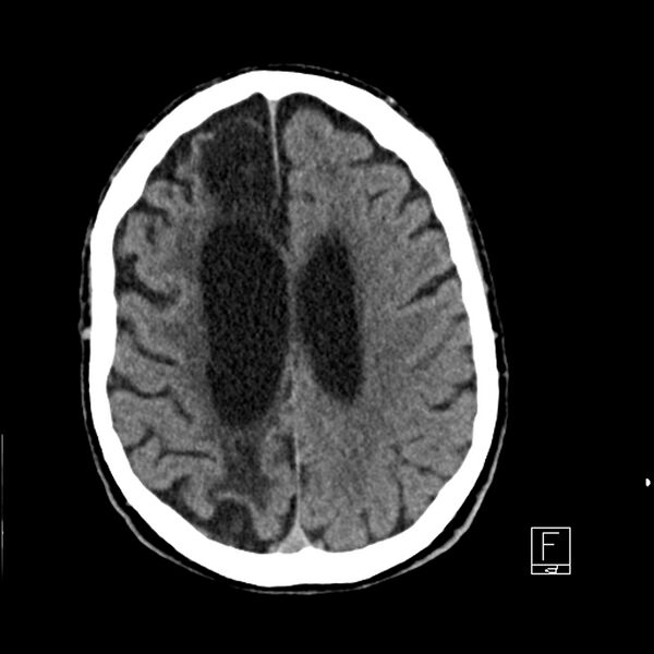 File:Acute ICA ischemic penumbra due to high-grade CCA stenosis (CT perfusion) (Radiopaedia 72038-82529 Axial non-contrast 33).jpg