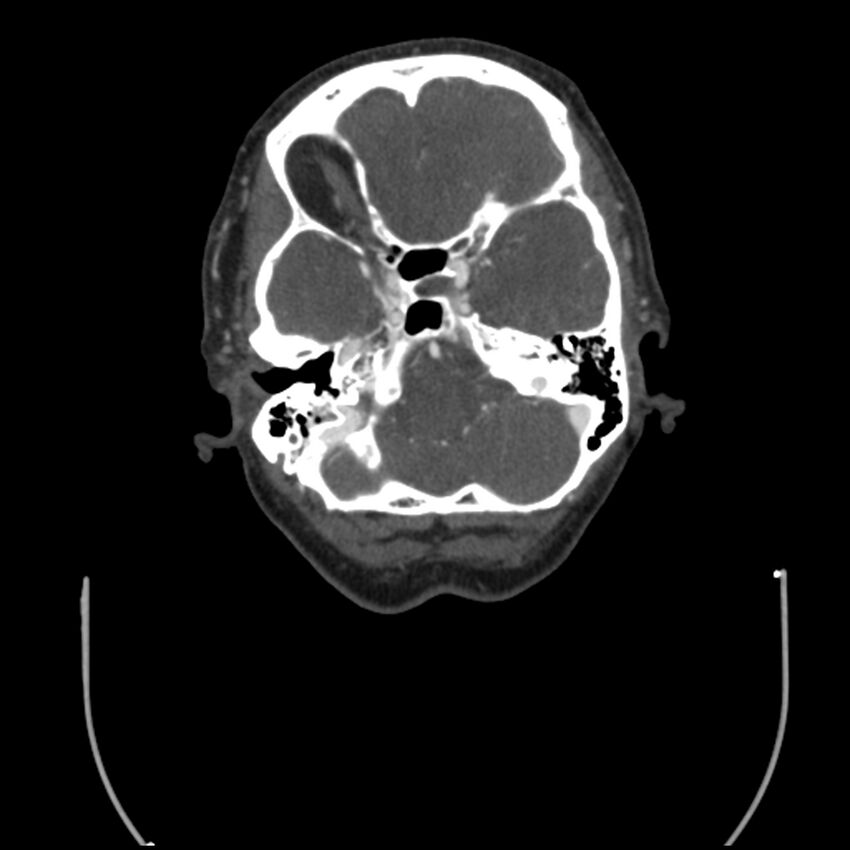 Acute M1 occlusion with ischemic penumbra (CT perfusion) (Radiopaedia 71897-82344 Axial C+ arterial phase thins 119).jpg