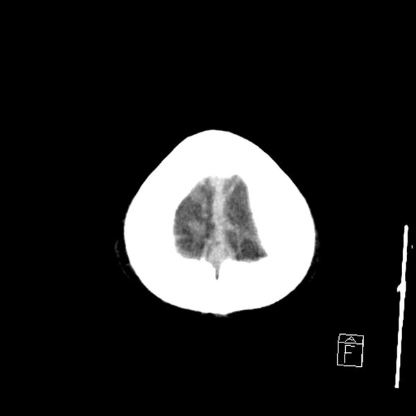 File:Acute P1 occlusion with PCA ischemia penumbra (CT perfusion) (Radiopaedia 72084-82586 Axial non-contrast 45).jpg