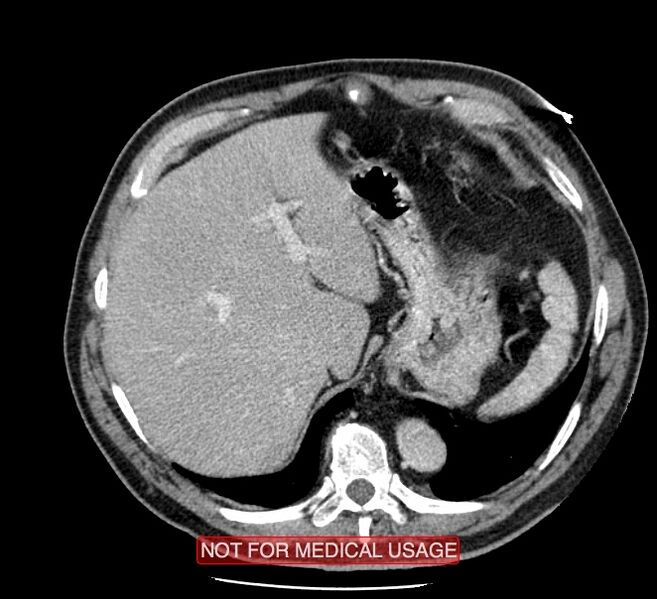 File:Acute aortic dissection - Stanford type A (Radiopaedia 40661-43285 Axial C+ portal venous phase 61).jpg