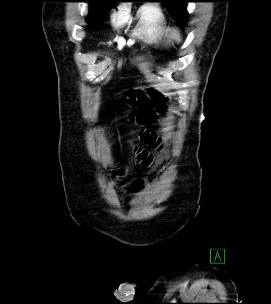File:Acute arterial mesenteric ischemia (Radiopaedia 78238-90828 Coronal C+ portal venous phase 19).jpg