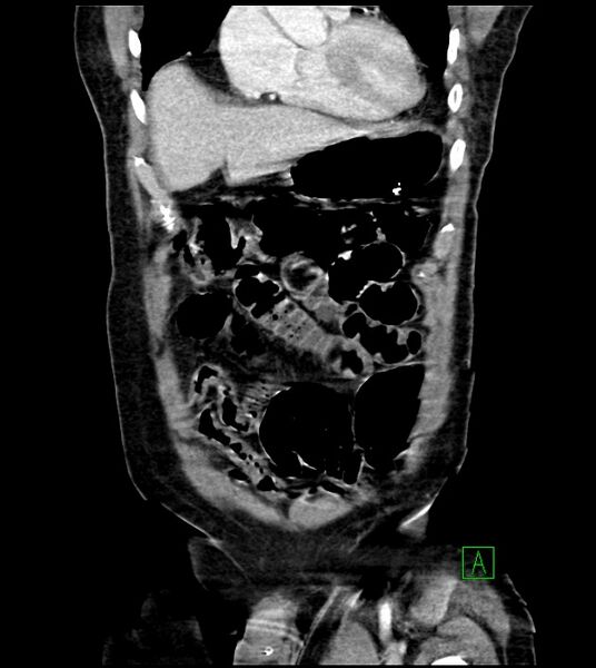 File:Acute arterial mesenteric ischemia (Radiopaedia 78238-90828 Coronal C+ portal venous phase 27).jpg