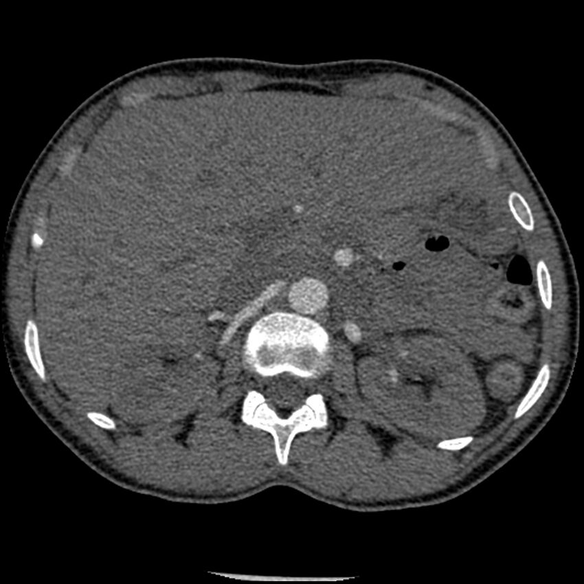 Acute chest syndrome - sickle cell disease (Radiopaedia 42375-45499 Axial C+ CTPA 223).jpg