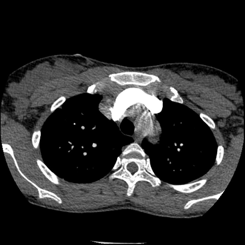 Acute chest syndrome - sickle cell disease (Radiopaedia 42375-45499 Axial C+ CTPA 46).jpg