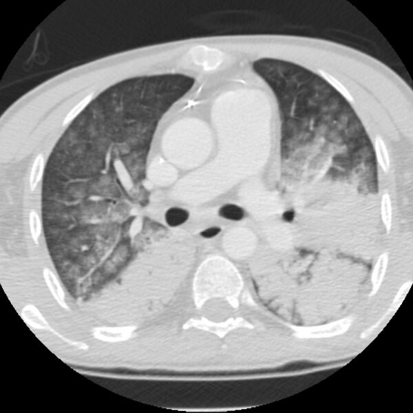 File:Acute diffuse alveolar hemorrhage (Radiopaedia 41323-44158 Axial lung window 24).jpg