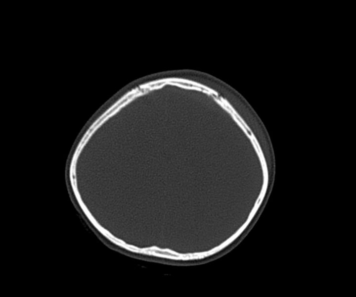 File:Acute epidural hematoma (Radiopaedia 63659-72335 Axial bone window 27).jpg