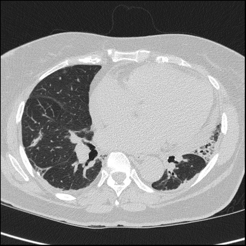 Acute interstitial pneumonitis (Radiopaedia 45404-49453 Axial lung window 51).jpg