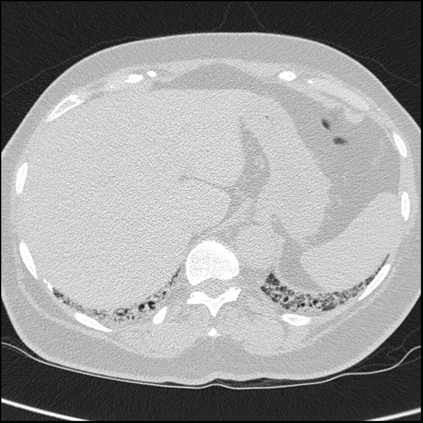 Acute interstitial pneumonitis (Radiopaedia 45404-49453 Axial lung window 72).jpg