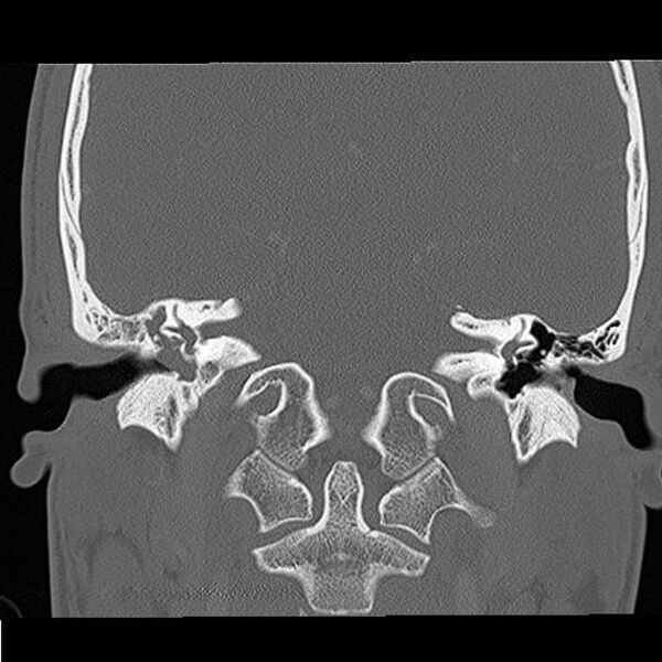 File:Acute otomastoiditis (Radiopaedia 28329-28575 Coronal bone window 10).jpg