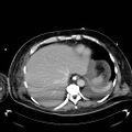 Acute pancreatic necrosis (Radiopaedia 13560-18503 Axial C+ portal venous phase 7).jpg